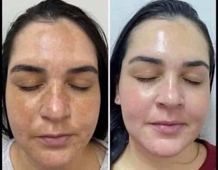Best Melasma Treatment in Anna Nagar: A Complete Patient Guide